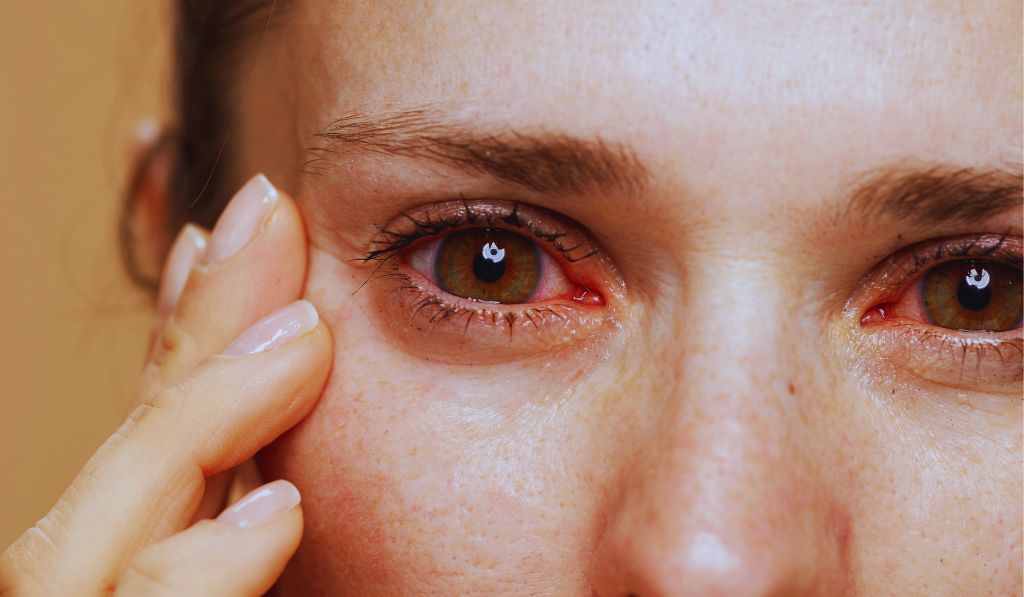 Proven Strategies to Combat Dry Eye Syndrome
